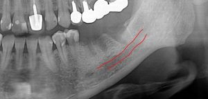 下顎奥歯のインプラント1