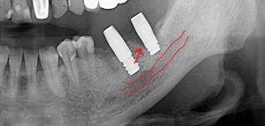 下あご奥歯のインプラント治療2