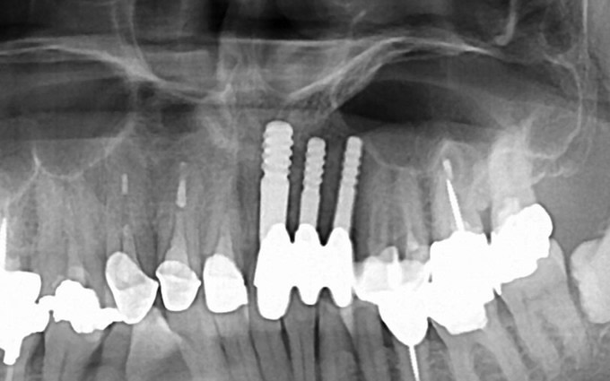 前歯部インプラントレントゲン