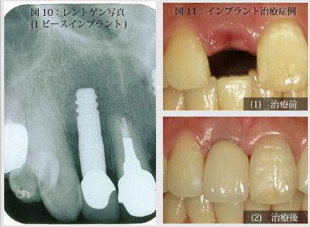 前歯のインプラント写真